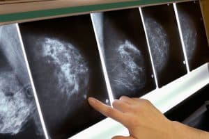 ماموگرافی-در-منزل