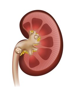 علائم سنگ کلیه