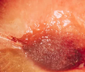 زگیل پوستی ناشی از ویروس HPV