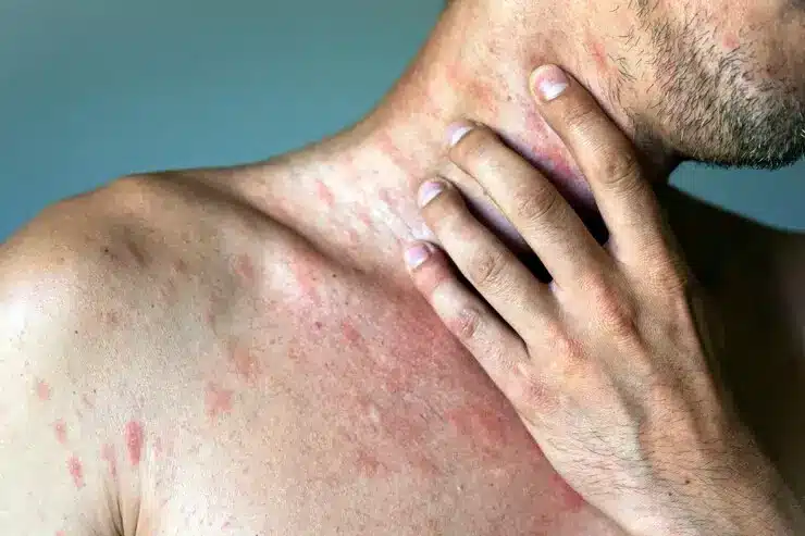 بثورات پوستی ایدز